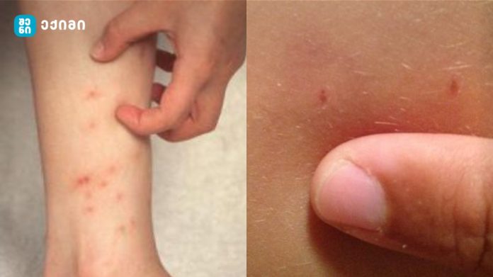 გაფრთხილება: თბილისში გავრცელდა კანის დაავადება — მუნი – მკურნალობისას რა არის საჭირო